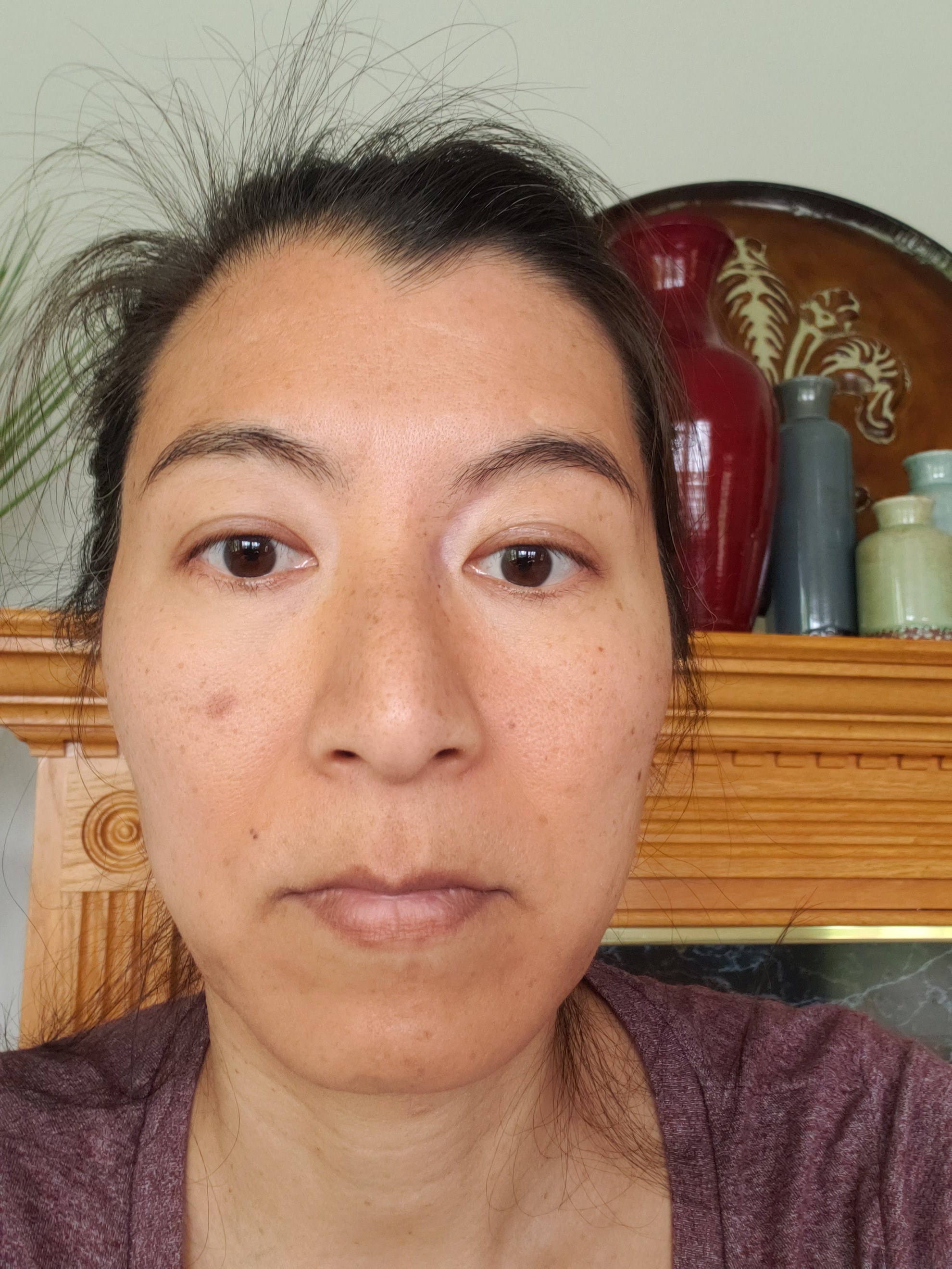 Before PRP Facial